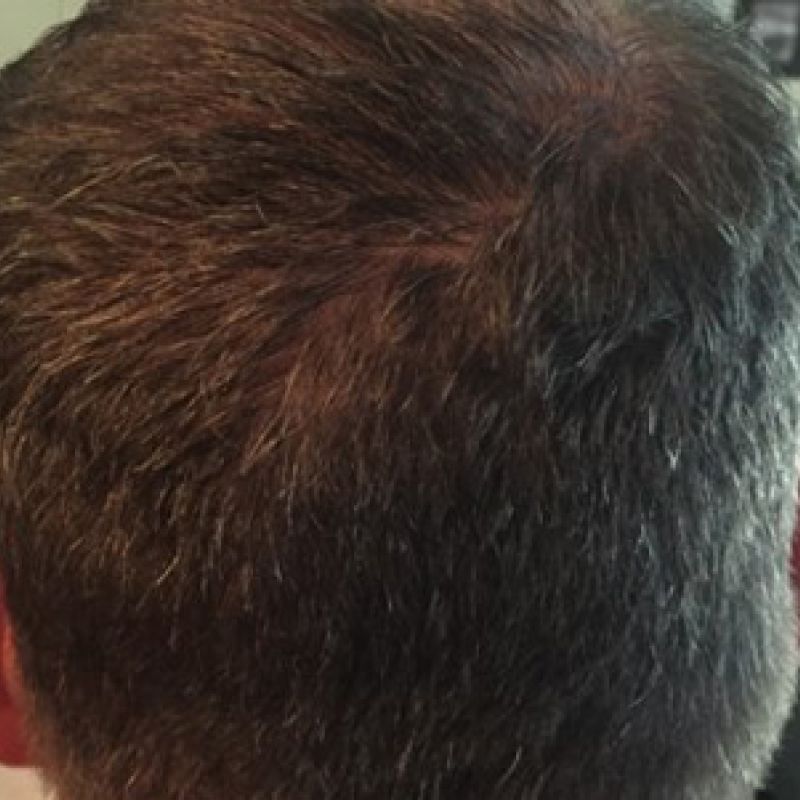 Prp Hair Restoration after