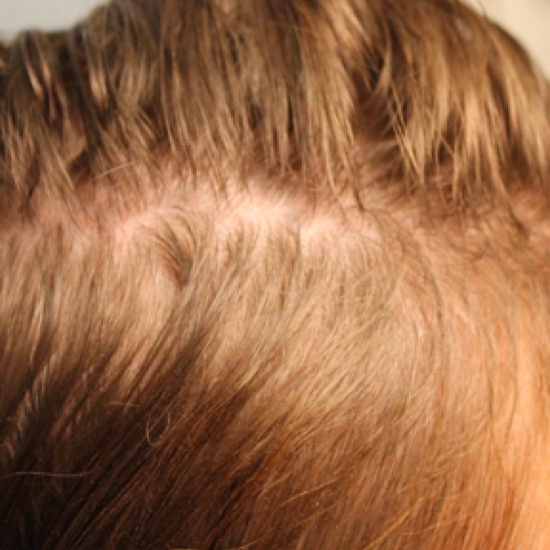 Prp Hair Restoration after