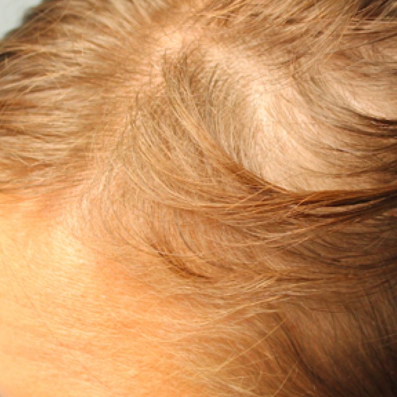 Prp Hair Restoration Before