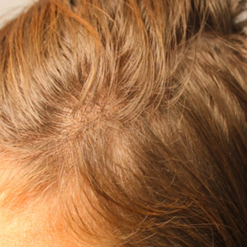 Prp Hair Restoration after