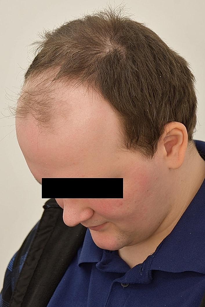 Facial Feminization Before & After
