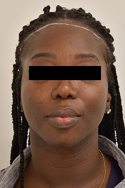 Facial Feminization Before & After